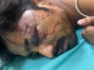 गुरुग्राम में लिफ्ट रुकने पर बवाल, नाराज युवकों ने ऑपरेटर पर किया हमला; आंख में गंभीर चोट, AIIMS रेफर